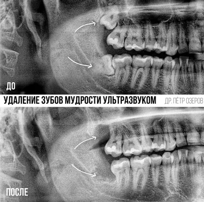 Удаление зубов - «Сложное удаление шестерок, альвеолит, осколки кости в  лунке и грануляция десны. Долгая реабилитация после сложных удалений,  дневник заживления с фото. » | отзывы