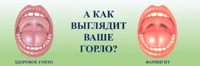 Что такое фарингит. Вирусный и бактериальный фарингит