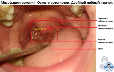 фарингит ангина, причины лечение - Клиника Сити Мед Оренбург