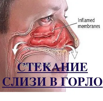 Бактериальное воспаление горла (фарингит)