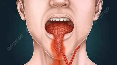 Фарингит – причины, симптомы, диагностика и способы лечения заболевания |  Клиника Будь Здоров