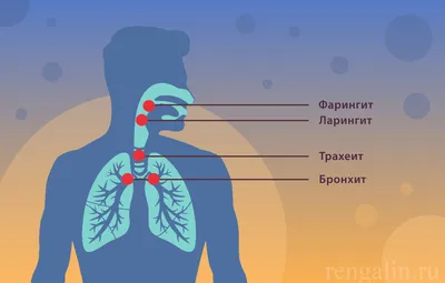 Фарингит: симптомы, диагностика, лечение