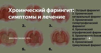 ХРОНИЧЕСКИЙ ФАРИНГИТ: ПРИЧИНЫ И ДИАГНОСТИКА – тема научной статьи по  клинической медицине читайте бесплатно текст научно-исследовательской  работы в электронной библиотеке КиберЛенинка