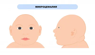 Фенилкетонурия - причины появления, симптомы заболевания, диагностика и  способы лечения