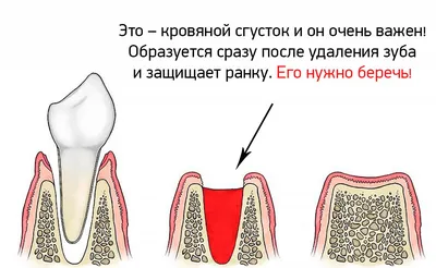 Имплантация собственных зубов. Пересадка зубов мудрости в ТОП1 клинике  Москвы – Немецкий имплантологический центр