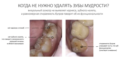 Состояние лунки после удаления зуба мудрости - Хирургическая стоматология -  Стоматология для всех