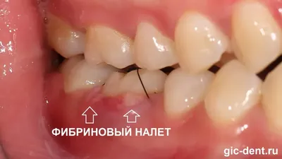 СТОМАТОЛОГИЯ КРЫМ 🦷 on Instagram: \"✓Очередной зуб мудрости моей терпеливой  пациентки @taniaivnenko обезглавлен и удалён 😊 ⠀ ✓Сложный случай - зуб был  под рядом стоящим зубом ⠀ 🤯изогнутые корни располагающиеся близко к