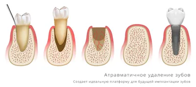 Обоснование применения метода сохранения лунки в области проводимой  имплантации при помощи рассасывающегося костного каркаса (4128) -  Имплантология - Новости и статьи по стоматологии - Профессиональный  стоматологический портал (сайт) «Клуб стоматологов»