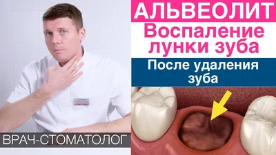 Гной после удаления зуба мудрости – почему так происходит и как лечить? |  TopDent | Дзен