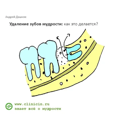 Рекомендации после удаления зуба — что нельзя делать, как ухаживать за  лункой, возможные осложнения