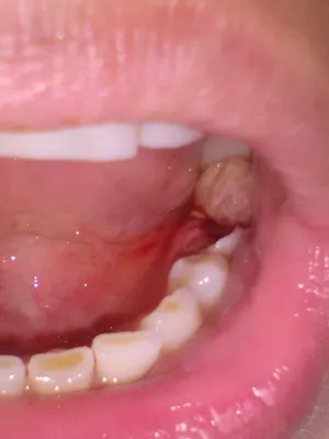 Волнения после удаления - Хирургическая стоматология - Стоматология для всех