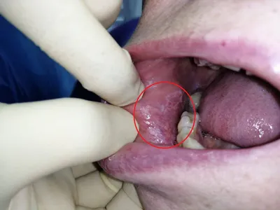 Стоматологія Максима Макаренка on Instagram: \"Что такое белый налет на  ранке после удаления зуба? ☑️Через несколько часов после удаления зуба в  лунке появляется темный сгусток — синеватого, черного, красного или бурого  оттенка.