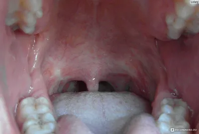Красный плоский лишай в полости рта: лечение