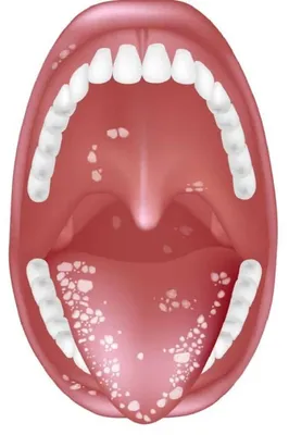 Удаление зубов без боли - стоматология Одонтосфера в Чернигове