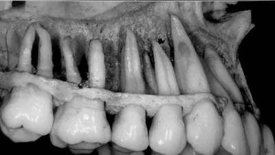 Налет на десне после установки зубного импланта | TopDent | Дзен