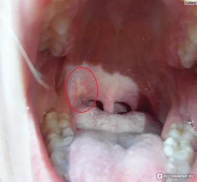 Белый налет на десне после удаления зуба - Underson Clinic