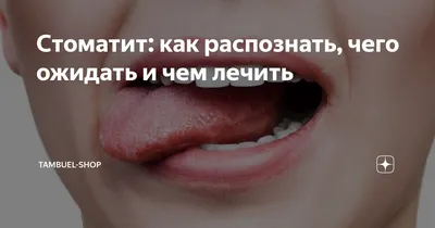 Лечение стоматита у детей: симптомы, классификация, профилактика | Цены на  стоматологические услуги в клинике Церекон в Москве