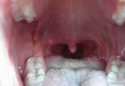 КРОК- 2. Стоматология. Детская хирургическая стоматология | PDF