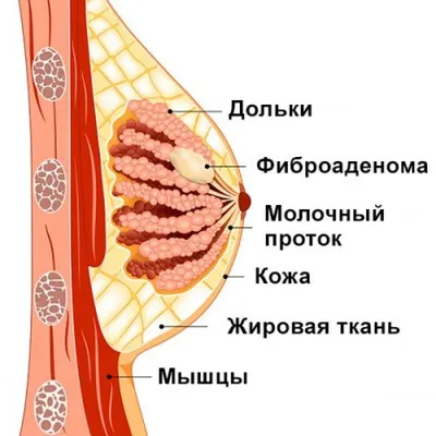 Фиброаденома молочной железы: симптомы, диагностика и лечение | ЛДЦ Здоровье