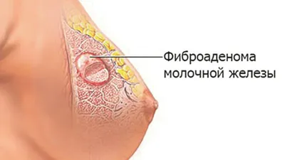 Чем отличается фиброаденома от кисты? | Маммологический Центр