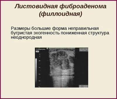 Фиброаденома молочной железы