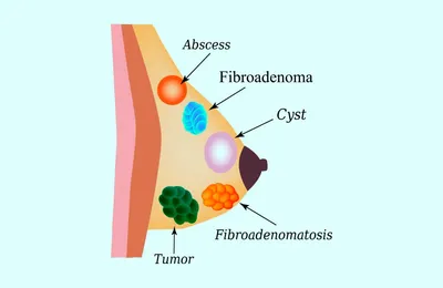 Фиброаденома | Городская клиническая больница им. В. М. Буянова