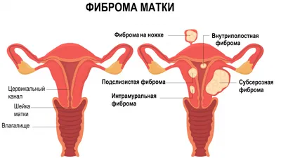 Фиброма полости рта – удаление фибромы лазером