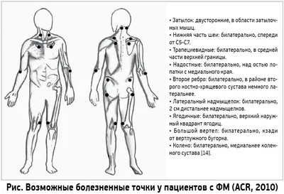 Фибромиалгии Симптомы Медицинского Вектора Иллюстрации Изолированы На Белом  Фоне Инфографики — стоковая векторная графика и другие изображения на тему  Фибромиалгия - iStock