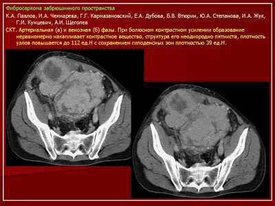 Онкология. Фибросаркома забрюшинного пространства. + | Портал радиологов