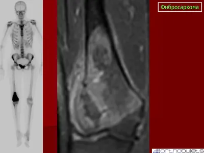 Онкология. Саркома. Фибросаркома. + | Портал радиологов