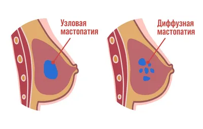 Фиброзно-кистозная мастопатия молочной железы: симптомы, диагностика,  лечение