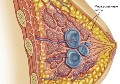Как отличить мастопатию от рака молочной железы | Клиника Меди Лайф