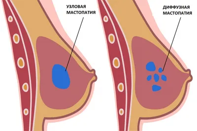 Мастопатия