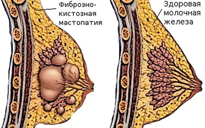 Мастопатия фиброзно-кистозная | Клиника МЕДЕЛ