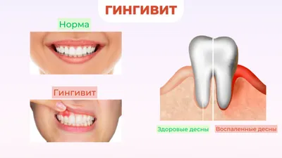 Периимплантит - симптомы, причины, лечение отторжения зубного импланта