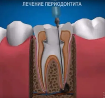 Экзостоз челюсти: методы удаления остеофитов, симптомы экзостоза десны —  ROOTT