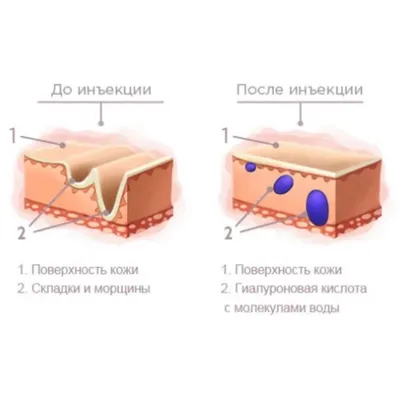 Филлеры ТОП лучших | лучшие филлеры рейтинг - ТОП 3 филлера для интимной  пластики