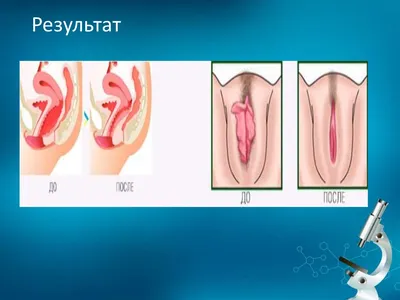 Филлер EsteFILL intim для гинекологии 1/1мл — купить по доступной цене от  производителя | МедАльянсГрупп