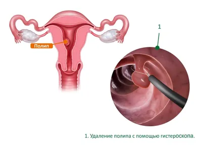 Выведение филлера из губ в Москве — Damas Medical Center