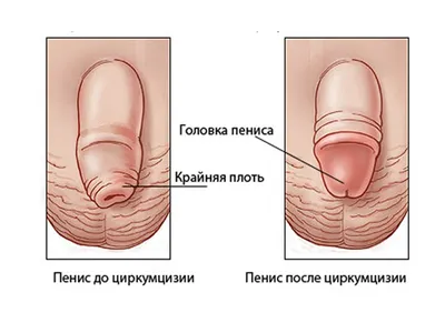 Москва - столица здоровья - Фимоз — это состояние, при котором отсутствует  возможность отодвинуть крайнюю плоть. Как следствие, появляются болезненные  ощущения, затрудненное мочеиспускание и воспаление. Фимоз может быть  врожденным, а может и