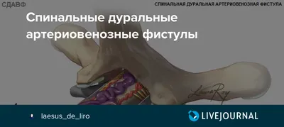 Гемодиализ и артериовенозная фистула