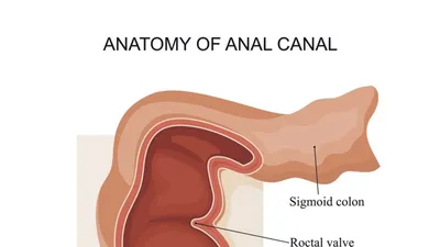 Спинальная дуральная артериовенозная фистула (Spinal dural...