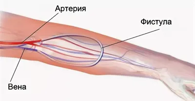 Мед. центр НУР Ош - ❗ФИСТУЛА? ЧТО ЭТО ТАКОЕ?❗ Существуют три основных типа  сосудистого доступа при гемодиализе: Артерио-венозная фистула, сосудистый  протез и центральный венозный катетер. Но сегодня поговорим о  артерио-венозной фистуле. Под