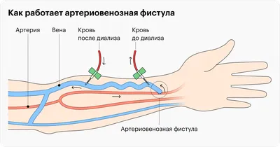 Mediterra.kz - Постоянный сосудистый доступ для гемодиализа  🔰Артериовенозная фистула и ее осложнения . 🔘Наш врач– Таждинов  Динмухаммед Бектурганович проводит формирование и реконструктивную операцию  артериовенозной фистулы. . 🔘Артериовенозная ...