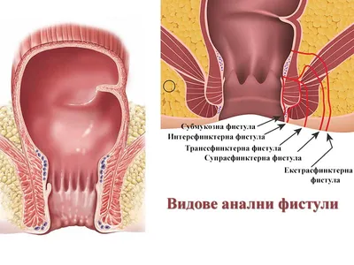 Фистула на зъб - Д-р Стоян Маринов