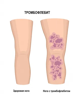 Флебит: пилефлебит, эндофлебит, панфлебит. Симптомы, диагностика, лечение