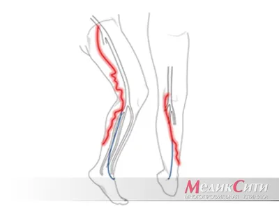 dr_vv.andreev - Диагностика и лечение постинъекционного тромбофлебита ⠀ ⠀  ————⠀ ⠀ ✓Клинические проявления: ⠀ ⠀ — боль⠀⠀ — полоса гиперемии в проекции  пораженной вены; ⠀ — плотный, резко болезненный тяж; ⠀ —