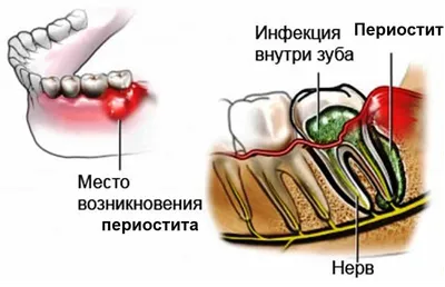 Флюс зуба — чем опасен? | Статьи стоматологии в Николаеве