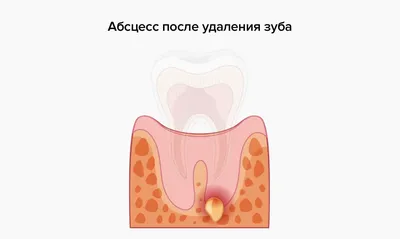 Флюс: причины, симптомы, методы лечения и профилактики | Dr.Miller