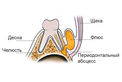 Флюс: основные причины и способы лечения — Клиника Лукашука